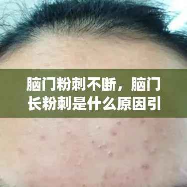 脑门粉刺不断,脑门长粉刺是什么原因引起的
